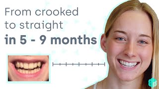 How to straighten crooked teeth easily and affordably without metal braces [upl. by Job]