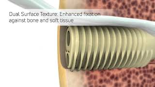 Eclipse™ Tenodesis Implant Animation [upl. by Lezti]