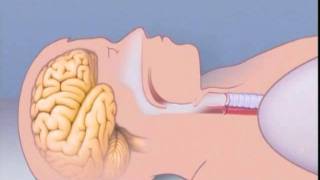 What Is Sleep Apnea [upl. by Arimahs]