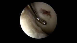 Arthroskopie des rechten Knies  Osteochondrosis Dissecans Part 6 [upl. by Adnuhsor]