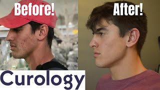 CUROLOGY BEFORE AND AFTER TEST Does it Work [upl. by Nyrual]