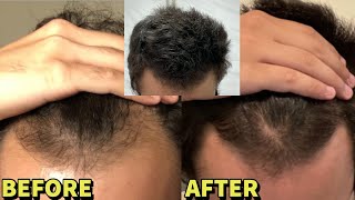 He REVERSED Hair Loss With JUST Dutasteride and Microneedling UNBELIEVABLE RESULTS [upl. by Eednil705]