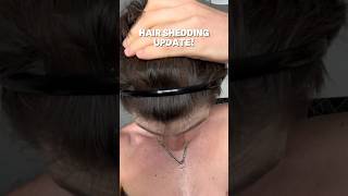 HAIR SHEDDING UPDATE 🚨 hairloss shedding [upl. by Lorinda]