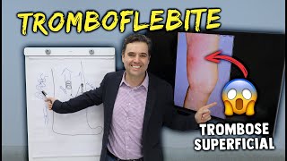 TROMBOFLEBITE  TROMBOSE SUPERFICIAL  Sinais sintomas e tratamentos [upl. by Clayson]