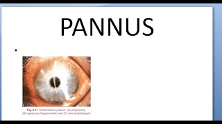 Ophthalmology Pannus Progressive Regressive Total Corneal Blinding Sequalae Difference Causes [upl. by Aira]