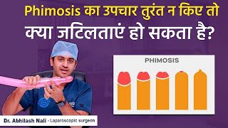 Phimosis Complications In Hindi  Live Demo on Tight Foreskin Treatment  Dr Abhilash Nali [upl. by Namolos]