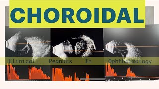 Choroidal Detachment  Haemorrhagic Vs Serous Atlas of B scan [upl. by Adnaram97]