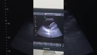 Pleural fluid on ultrasonography [upl. by Mannie]