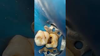 Molar 🦷 root canal treatment dentist dental dentalprocedure [upl. by Alyhs398]