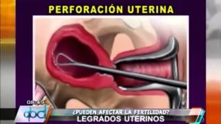 PROCREAR ¿Los legrados uterinos afectan la fertilidad [upl. by Dnomsed]