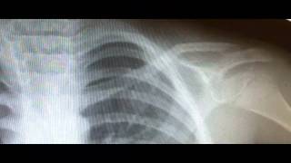 Clavicle Fracture Xray Findings and Treatment [upl. by Wixted]