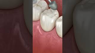 Dental Restoration Composite Bonding Teeth 3D Medical Animation asmr animation shorts trending [upl. by Nanreik]