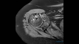 Subcoracoid impingement in 60 year old [upl. by Artapoelc]