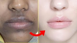 How To Remove Dark Black Patches Dark Spots Hyper Pigmentation Around Your Mouth  Home Remedies [upl. by Alta]