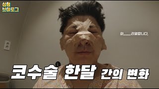 108편 남자 코수술 브이로그 솔직 리얼후기ㅣ수술 직후 한달차 [upl. by Eelta]