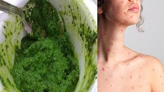 3 Best Home Remedies for Folliculitis [upl. by Isaacson587]