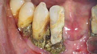 My Experience With SEVERE Gum Disease Periodontal disease diagnoses treatments amp natural healing [upl. by Anaitak543]