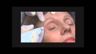 Traitement des paupières sans chirurgie blépharoplastie avec la technique Plexr à AixenProvence [upl. by Alithea]