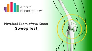 Rheumatology KNEE exam Sweep Test for Joint Swelling or Effusion [upl. by Elkin]