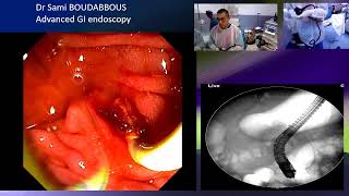 ERCP for acute cholangitis [upl. by Nanji]