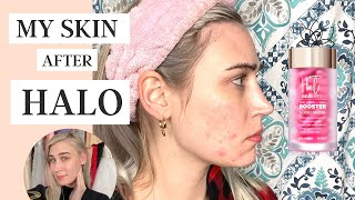 My Skin After Using Halo Beauty Vitamins  Did They Work [upl. by Adnilahs]