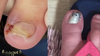 😱ELA TINHA UM TUMOR NA UNHA nails ingrowntoenail [upl. by Ajnos982]