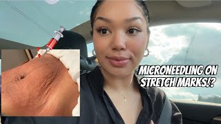 Microneedling on Stretch Marks  Vlog pt 1 [upl. by Jillayne152]