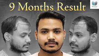 1st Hair Transplant Results after 9 Months  Hair Transformation Journey at Medlinks [upl. by Ynnavoj28]