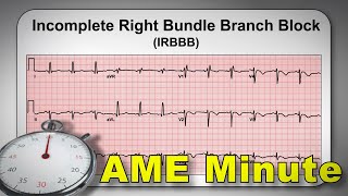 AME Minute Why is an Incomplete Right Bundle Branch Block considered a normal variant [upl. by Petigny741]