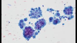 Mesothelioma cytology [upl. by Mchail511]