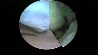 Before and After Microfracture Articular Cartilage Repair  Dr Steven Struhl [upl. by Chalmer37]