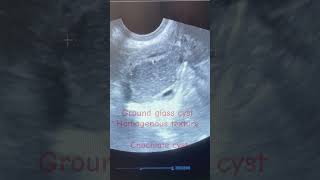 Endometriosis infertilityChochlate ovary cyst treatmenttrendingshorts viralsongendometriosisivf [upl. by Nebeur735]