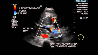 Color Doppler of Cavernous Transformation of the Portal Vein  Case Study [upl. by Bronny]