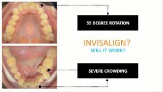 Dr Ibrahim Invisalign Case Review Rotations With AcceleDent [upl. by Colbye221]