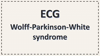 WPW syndrome  ECG  Wolff Parkinson White Syndrome ECG changes simplified  Delta Wave [upl. by Arevle]