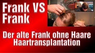 Haartransplantation Franky Youtube Haarverpflanzung Erfahrung Türkei Medical Exclusive Istanbul [upl. by Beverie350]