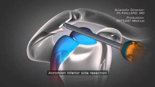 Shoulder Arthroscopy  Acromioplasty [upl. by Forcier]