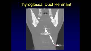 Journal Club Thyroglossal Duct Carcinoma [upl. by Garap]