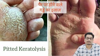 Pitted Keratolysis  Erythrasma  पैर पर होने वाले गड्ढे का इलाज़ fungalinfection fungalinfections [upl. by Humo422]