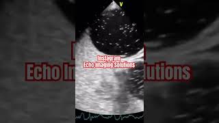 Patent Foramen Ovale echocardiography echocardiogram cardiology [upl. by Soane812]