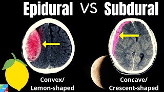 Subdural Hematoma VS Epidural Hematoma  Intracranial Hemorrhages [upl. by Marissa805]