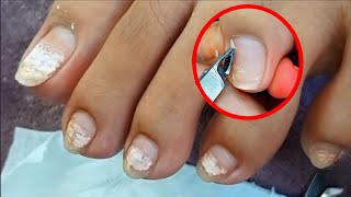 Satisfying Ingrown Toenail Removal  Dry Skin  Pedicure 126 [upl. by Atilef311]