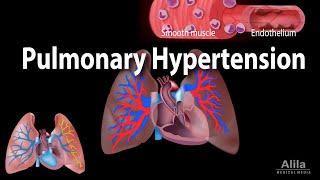 Pulmonary Hypertension Animation [upl. by Leugim]