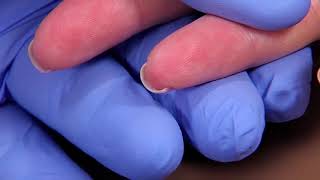 Perform a Capillary Puncture Obtain a Blood Sample by Capillary Puncture [upl. by Gnos]