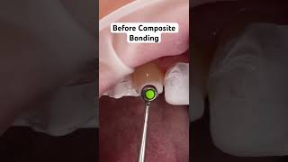 What does Composite Bonding do to your teeth dentist dentalmakeover compositebonding [upl. by Violante260]