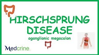 Hirchsprungs Disease Aganglionic Megacolon [upl. by Eurydice]