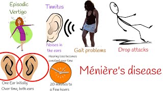 Vertigo and noise in the Ears Menieres disease Ménières disease [upl. by Eatnoid92]