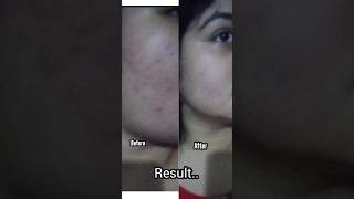 Mistine Acne clear Facial foam review shorts review 1week challenge [upl. by Deroo]