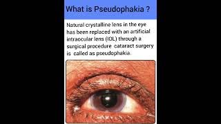 What is Pseudophakia  Optometry Fans [upl. by Rollie]