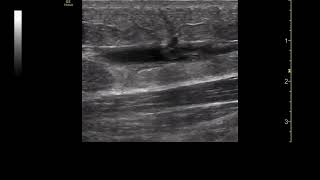 Thrombose veineuse superficielle Saphène Interne Échographie [upl. by Farman]